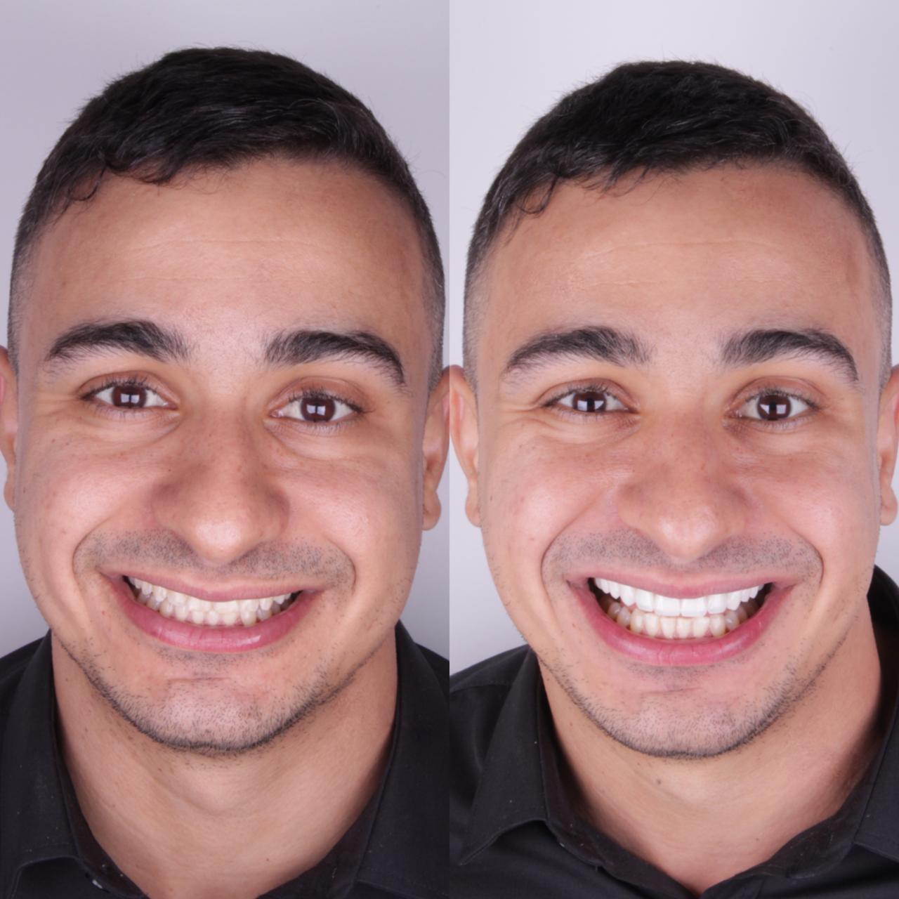 Antes e depois das lentes de resina