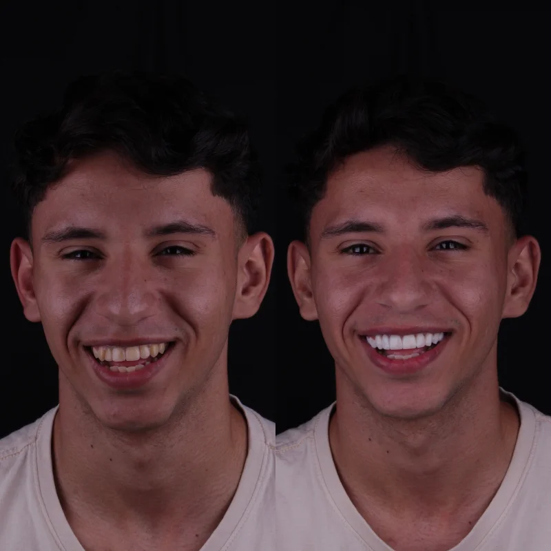 Antes e depois das lentes de resina