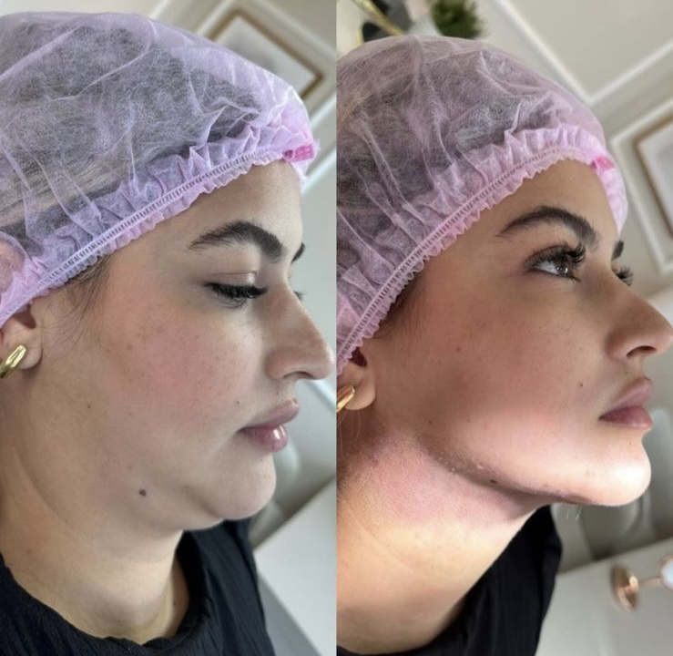 Antes e depois da lipo de papada