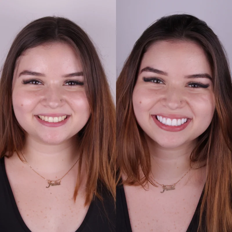 Antes e depois das lentes de resina