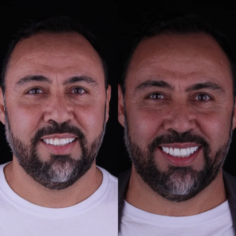 Antes e depois das lentes de resina